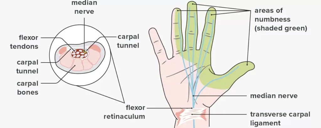 CARPAL TUNNEL SYNDROME