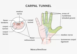 CARPAL TUNNEL SYNDROME