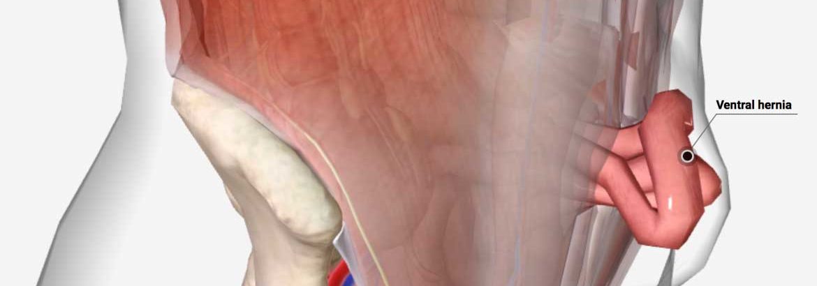 FEMORAL HERNIA – CSF Surgery