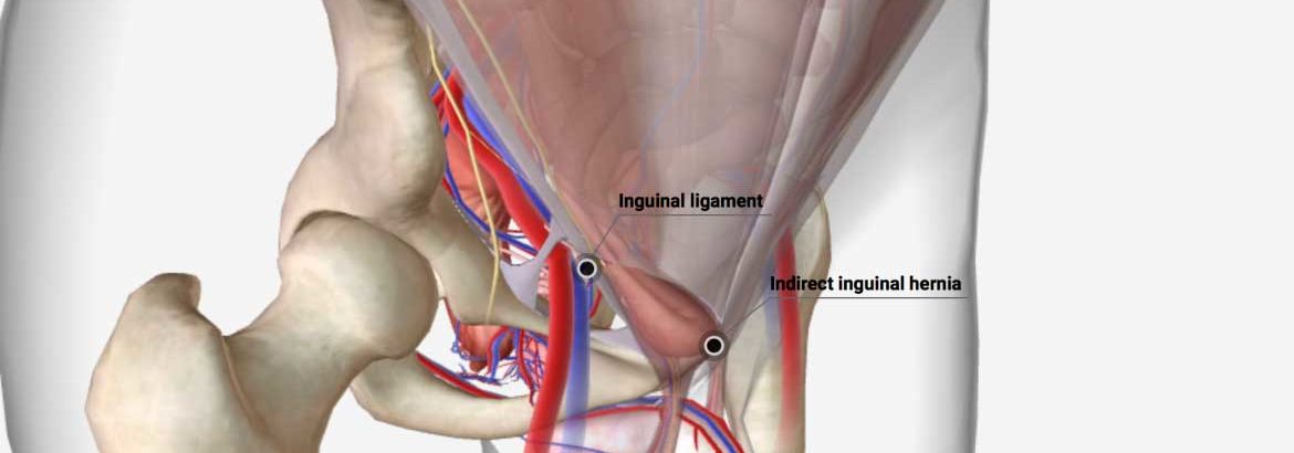 INGUINAL HERNIA REPAIR – CSF Surgery