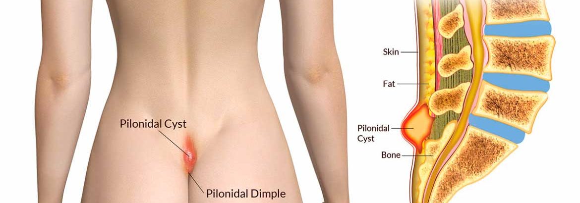 https://www.csfsurgery.com/wp-content/uploads/2022/05/GS-PILONIDAL-CYST-1-1170x410.jpg