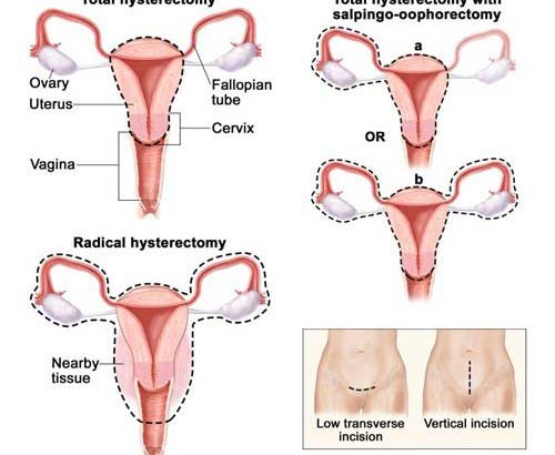 About Your Total Abdominal Hysterectomy and Other Gynecologic Surgeries