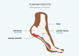 Plantar Fasciitis