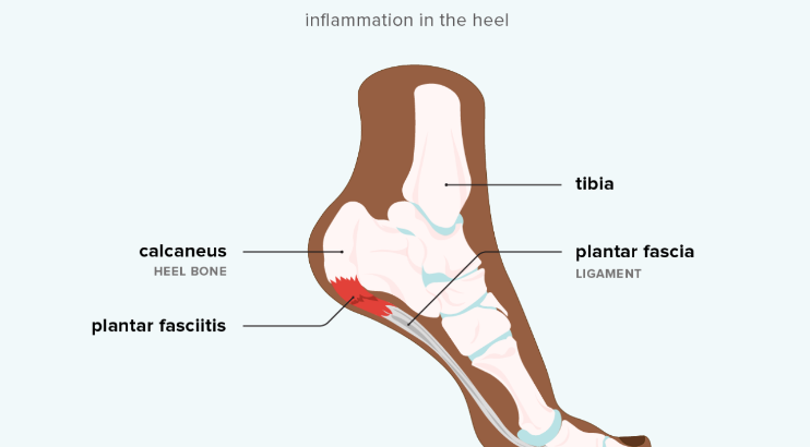 Do you have plantar fasciitis pain? Learn more from Dr. Inman