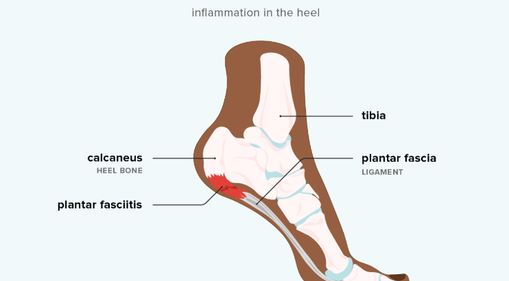 Plantar Fasciitis